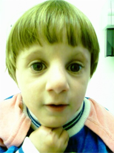 Figure 1 High forehead with flat supraorbital ridges and widely spaced eyes.