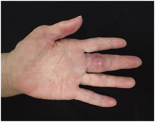 Figure 3. Photo of hands before the third synovectomy. Redness and swelling on the middle finger are visible.