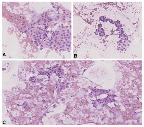 Figure 1 Cytological specimens of TNs assigned to the AUS/FLUS category of TBSRTC. Hematoxylin and eosin staining, 400× magnification. (A) Cytological atypia. Some cells have mild nuclear enlargement and slight nuclear pleomorphism. (B) Predominant population of microfollicles in an aspirate. (C) Cellular sample composed almost entirely of Hürthle-like cells in a sparse cellular aspirate. Atypia of undetermined significance presenting focal crowded follicular cell clusters with abundant colloid. AUS/FLUS: atypia of undetermined significance/follicular lesion of undetermined significance; TBSRTC: The Bethesda System for Reporting Thyroid Cytopathology.