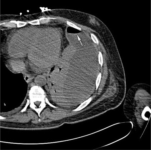 Fig. 2 CT scan of the chest showing the loculated left pleural fluid collection with air-fluid level (arrow) and the adjacent parenchymal consolidation.