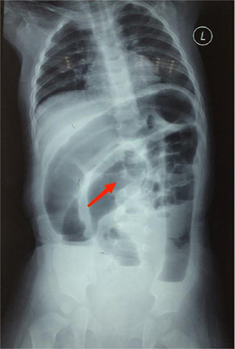 Figure 1 Erect abdominal radiograph reveals significant dilatation of the intestine, as the red arrow shows.
