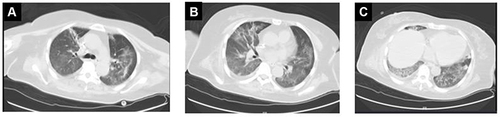 Figure 5 Chest CT of case 3 showed diffuse ground-glass opacities in both lungs (A–C).