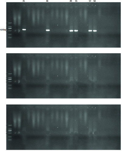 Figure 3 Detection of NDM genes of carbapenem-resistant Acinetobacter baumannii clinical isolates by PCR.