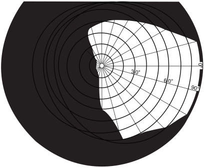 Figure 1 Binocular visual field plot representing a left-sided hemianopia.