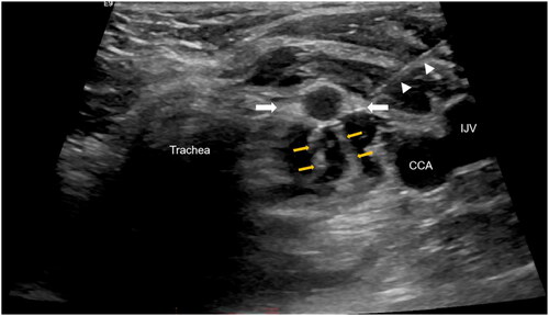Figure 2. Postoperative adhesion during hydrodissection. A 39-year-old patient with SHPT and a previous PTX history underwent hydrodissection using a 18G PTC needle (white arrowhead). Within the echoless isolation fluid, several cord-like hyperechoic bands (yellow arrows) were observed, pulling the SHPT lesion (white arrows) and the surrounding structures. Note: SHPT: secondary hyperparathyroidism; PTX: parathyroidectomy; CCA: common carotid artery; IJV: internal jugular vein.