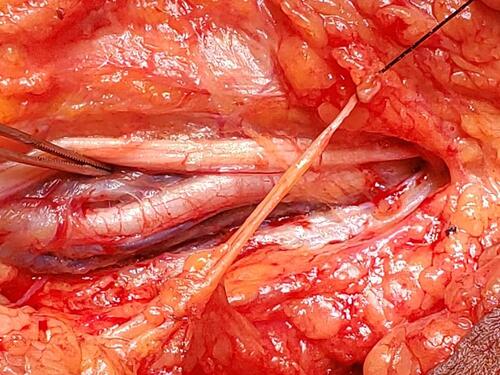 Figure 1 Brachial artery, devoid of blood flow prior to embolectomy.