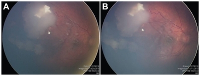 Figure 4 (A) Fundus photograph of the right eye showing partially regressed superotemporal tumor and vitreous seeds overlying the macula. (B) Same view of right fundus showing no regression of the vitreous seeds despite three sessions of intra-arterial chemotherapy.