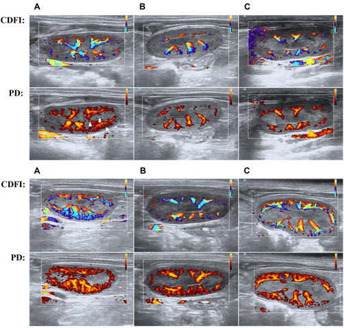 Figure 6 The comparison of Sham group (a and A), CLP group (b and B), CLP+Cur group (C and c) using renal Power Doppler and CDFI. ▲segmental artery, ⇓interlobar artery, ↖interlobular artery. Overall, blood flow at 24h after CLP (A–C) was better than 12h after CLP (a–c). The Sham group was better than CLP+Cur group and CLP+Cur group was better than CLP group. Power Doppler is more sensitive in flow detection than CDFI (n = 8 per group).