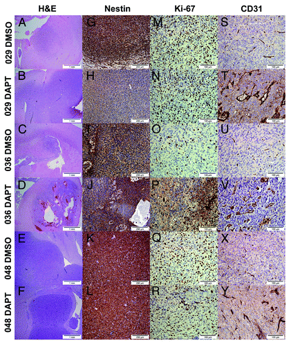 Figure 4. Histology and expression of the stem cell marker Nestin, the proliferative marker Ki-67 and the endothelial cell marker CD31 differed between tumors formed from DMSO and DAPT-treated neurosphere cells. (A–F) H&E of representative tumors from each treatment group of the three tumor-types. Scale bar shows 1 mm. (G–L) Immunodetection of the stem cell marker Nestin. Positive cells stain dark brown in the cytoplasm. Scale bar shows 200 μM. (M–R) Immunodetection of the proliferative marker Ki-67. Positive nuclei are stained dark brown. Scale bar shows 100 μM. (S–Y) Immunodetection of the endothelial marker CD31. Normal vessels are shown as strait brown stripes in the section, while abnormal vessels are detected as disorganized vessels often with multiple endothelial cells constituting the vessel wall. Scale bar shows 100 μM.