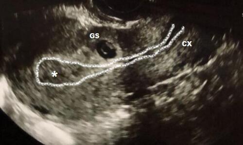 Figure 1 Transvaginal ultrasound showing cesarean scar pregnancy. *Empty endometrium with empty, closed cervix.