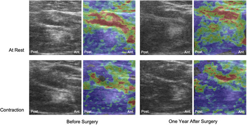 Figure 3 Elastography images at rest and during contraction before and one year after surgery.