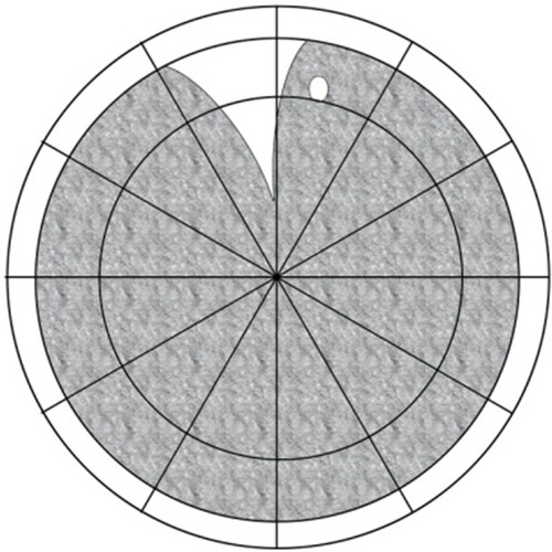 Figure 9 Group 7: almost total detachment except for a superior wedge-shaped attachment.