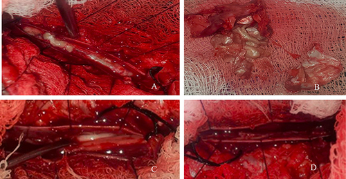Figure 2 (A–D) Intraoperative picture demonstrating tumor after dural opening and myelotomy, tumor samples and complete tumor removal.