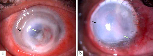 Figure 2 (a) Digital slit-lamp image of the patient depicting diffuse conjunctival congestion, superficial vascularization, total full-thickness corneal infiltrate with 360-degree limbal infiltrate and paralimbal thinning (black arrowhead) with central impending perforation (white arrowhead) (severe ulcer). (b) Digital slit-lamp image of the patient depicting diffuse conjunctival congestion, total graft infiltrate (black arrowhead), graft host junction melt from 1 to 7 o’clock (white arrowhead) and loose sutures along with superficial vascularization.