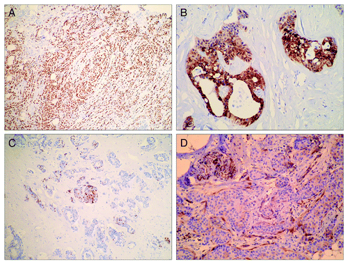 Figure 1. Immunocytochemical analysis of PTEN expression in breast cancers. (A) Nuclear PTEN immunoreactivity in invasive lobular breast carcinoma (IHCx40); (B) cytoplasmatic PTEN immunoreactivity in invasive ductal breast carcinoma (IHCx200); (C) heterogeneity of nuclear PTEN immunoreactivity in invasive ductal breast carcinoma (IHCx40); (D) negative PTEN immunoreactivity in invasive ductal breast carcinoma; nerve and fibrocytes as positive controls (IHCx100).