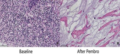 Figure 1 (A) The pathological findings of colonoscopy biopsy. It shows that atypical cells are arranged in an irregular glandular tube-like arrangement, with large and deeply stained nuclei and obvious mitosis (H&E, 40x). (B) The microscopic findings of the resected specimen. There is only mucus but no exact cancer cells were found (H&E, 40x).