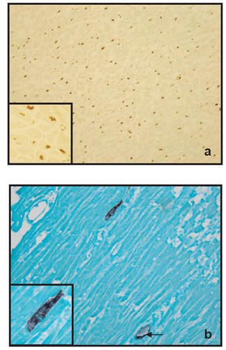 Figure 3 Figure 3 (a) TUNEL-positive myocytes nuclei (brown) demonstrated with the ApopTag kit. The transverse section is from the left ventricle in a case of SND (× 200 magnifications). The insert: Higher magnification (× 400) of the same section showing complete labelling of myocytes nuclei. (b) Myocytic necrosis visualized by the binding of antibody against the terminal complement complex (purple) to the sarcolemma. The longitudinal is from the left ventricle in a case of LLT group (× 200 magnification).Insert: Higher magnification (× 400) of the same section showing immunoreactivity of cardiac myocytes to the C9-mab. The endothelium of intramyocardial vessels also reacted with C9-ab and used as an internal control (arrow).
