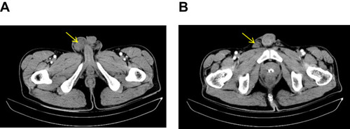 Figure 1 Enhanced computed tomography images. (A) Metastatic tumour of the right testis (arrow); (B) Metastatic tumour of the right spermatic cord (arrow).
