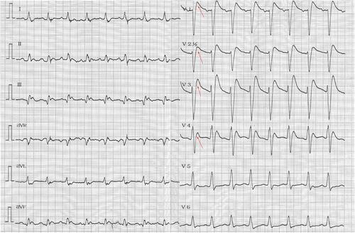 Figure 3 A BrP in leads V1-V4 and sudden cardiac death occurred in this patient. A BrP with ischaemic J wave is indicated by the red arrows.