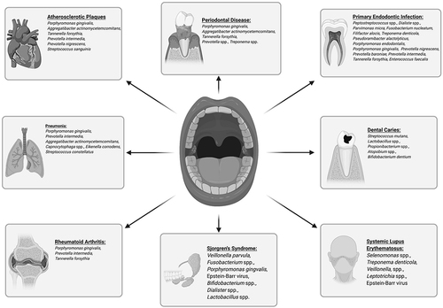Figure 2 Oral microbiome dysbiosis is associated with various local and systemic conditions.