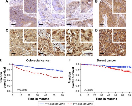 Figure 1 Nuclear DDX3 correlates with worse survival in colorectal and breast cancer patients.