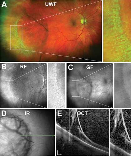 Figure 13. 86 year old Caucasian male with degenerative retinoschisis. (A) UWF, (B) red-free, (C) green-free and (D) infra-red imaging highlight the transparent dome-shaped elevation of the retina associated with retinoschisis. (E) Peripheral OCT highlights the splitting of the inner retinal layers and remnants of intraretinal pillars. Abbreviations as in Figure 3.