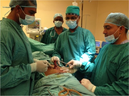 Figure 2 Photograph of the first recorded single incision laparoscopic cholecystectomy to be performed in Guyana.