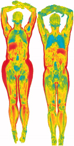 Figure 2. ‘Imiomics analysis’ of fat mass measured by bioimpedance in females (left) and males (right). A correlation analysis was performed between fat mass and the relative volume of each image element in the 3D magnetic resonance image. Each image element is then color-coded according to the correlation coefficient, where dark red represents a high positive correlation coefficient and blue a high negative correlation coefficient. Unpublished data from Robin Strand, Joel Kullberg, and Håkan Ahlström at the Department of Radiology, Uppsala University.