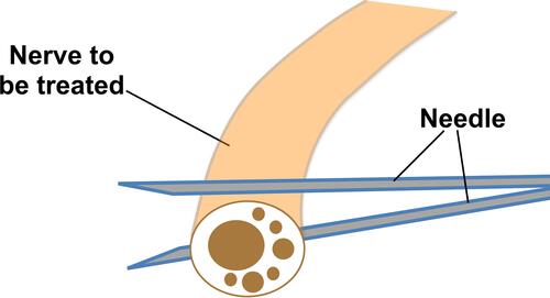 Figure 7 Needle position for method 1 of hydrodissection (HD) of nerves. With the “in-plane” technique, first, the inferior surface of the nerve is hydrodissected with the needle bevel positioned up; and thereafter, the superior surface of the nerve is hydrodissected with the needle bevel positioned down.