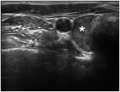 Figure 1. Ultrasonic scan of a parathyroid adenoma. (* = Adenoma).