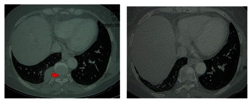 Figure 5 The patient with pleural metastases of thymoma shown by preoperative CT (right) and with no evidence of local recurrence showed by CT scan 1.5 years after surgery (left).