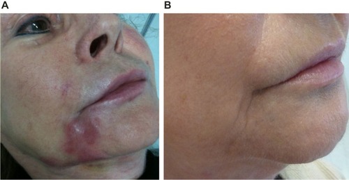 Figure 9 Inflammatory foreign body granuloma before and after treatment with an antibiotic, 5-FU, triamcinolone, and local anesthetic.