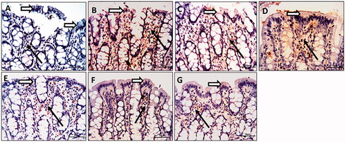 Figure 7. Olmesartan medoxomil self-microemulsifying drug delivery system (OMS) nanoformulation decreases matrix metalloproteinase-9 (MMP-9) overexpression in trinitrobenzene sulfonic acid (TNBS)-induced colitis in rats. Photomicrographs of colonic sections immunostained for MMP-9 in the surface epithelium (white arrow) and connective tissue cells of lamina propria (black arrows) (× 20): (A) Normal control group showed a faint reaction. (B) TNBS-colitic (Positive control) rats showed marked overexpression of MMP-9. (C) Sulfasalazine and (G) Olmesartan medoxomil self-microemulsifying drug delivery system high dose groups showed marked improvement with a marked decrease in the number of positively stained cells. (D) Olmesartan medoxomil low dose revealed mild improvement. (E) Olmesartan medoxomil high dose and (F) Olmesartan medoxomil self-microemulsifying drug delivery system low dose groups showed moderate improvement.