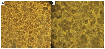 Figure 3 (A) HER2-positive KB cells exposed to anti-HER2 immunonanoshells (nanobody-conjugated nanoshells). (B) Cytotoxicity was observed in cells treated with near-infrared laser. Images represent cells targeted with anti-HER2 nanoshells only.