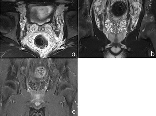 Figure 4 (a–c) shows the MRI manifestations of normal seminal vesicles. (a) shows the equal size of bilateral seminal vesicles on the transverse section of the T2WI fat-suppressed sequence in the pelvic cavity. The seminal vesicle fluid shows high signal, and the folds show slightly low signal (white arrow); (b) shows the equal size of bilateral seminal vesicles on the coronal section of the T2WI fat-suppressed sequence in the pelvic cavity. The seminal vesicles show high signal, and the folds show slightly low signal (white arrow). The image of tortuous Vas deferens can be seen on the inside of the seminal vesicles; (c) Pelvic T1WI fat-suppressed sequence enhancement scan shows mild enhancement of normal seminal vesicle gland folds at transverse section, but no enhancement of seminal vesicle fluid (white arrow).