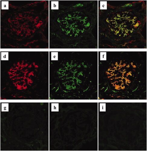 Figure 5. Immunofluorescence staining for complement components in MPO-AAGN. a–c. Representative image of direct double immunofluorescence staining for panC3 (a: Alexa Fluor 594: red) and C5 (b: Alexa Fluor 488: green) of a renal biopsy specimen of a patient with MPO-AAGN (case 3). A merged image is shown in (c). d–f. Representative image of indirect double immunofluorescence staining for C4d (d: Alexa Fluor 594: red) and C5b-9 (e: Alexa Fluor 488: green) on a renal biopsy specimen of a patient with MPO-AAGN (same patient as a–c). A merged image is shown in (f). Representative images of single IF staining for factor Bb neo antigen (g), mannan-binding lectin serine peptidase (MASP)-1 (h), and MASP-2 (i) on renal biopsy specimens of the same patient.