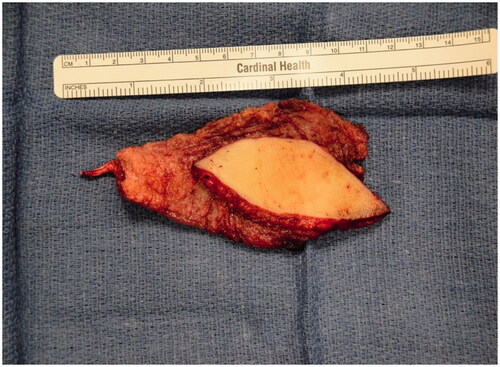 Figure 4. Intra-operative photograph of the latissimus dorsi flap after dissection and before anastomosis and inset.