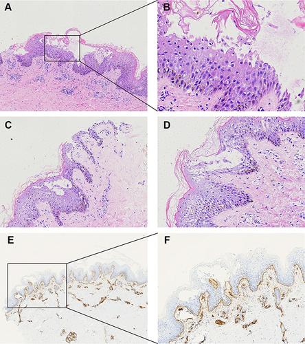 Figure 2 Histopathological characteristics of the lesions. (A, C, D) Skin biopsy of right thigh showed intra-epidermal blisters which could be seen on the basal cells and under the stratum corneum; acantholytic cells, hyperplasia of stratum spinosum, basal vacuolization. A few scattered eosinophils can be seen in the shallow depth of the dermis (haematoxylin and eosin stain, original magnification x200). (B) Figure 2A enlarged to x400, the acantholytic cells could be observed in the blister. (E) Type IV collagen immunohistochemistry suggested intra-epidermal blisters (original magnification x40). (F) Original magnification x100.
