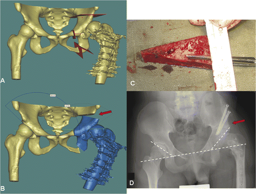 Figure 2. Periacetabular osteotomies (red planes) were planned on a virtual 3D pelvic model generated from the patient's CT data using MIMICS software (A). The acetabular bone segment (blue) was virtually realigned until the measured acetabular angle was adequate or equal to that on the opposite side (B). The resulting bone defect created above the acetabulum (red arrow in B) could be measured and its dimensions used to guide the harvesting of a bone graft from the ipsilateral iliac crest (C). A postoperative plain radiograph (D) showed good fitting of the bone graft and alignment of the acetabulum (dotted line).