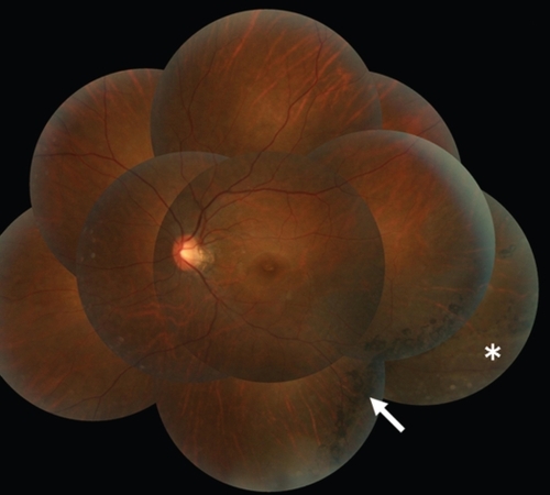 Figure 5 Case 2 Panoramic fundus photograph of left eye four years after onset. The localized retinal detachment (*) is well-demarcated by pigmentation (arrow).