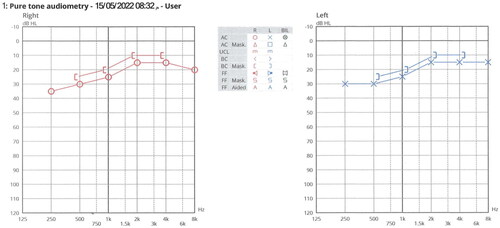 Figure 1. Example of typical bilateral low-frequency sensorineural hearing loss present in 16 patients included in the study.