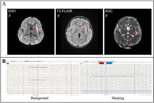 Figure 2. Brain imaging and Electroencephalogram (EEG). Panel A: Magnetic resonance imaging (MRI) of the brain performed on day 6 of the illness showed obvious abnormal signals on DWI (abnormally hyperintensity in the left insula and parietal lobe), ADC (abnormally hypointensity in the left insula and parietal lobe), and T2-FLAIR images (slightly hyperintensity in the left insula lobe) (marked with an arrow). Panel B: EEG on day 6 of the illness presented the relative enhanced θ and δ activities with the continuous asymmetrical low waves manifested spike, sharp, or slow wave complex (marked with a black line).