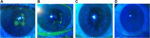 Figure 1 Right eye of a 56-year-old patient with dendritic epithelial keratitis during the follow-up period ((A): baseline; (B): after 3 days; (C): after 4 days; (D): after 7 days).