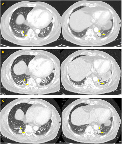 Figure 1 Computed tomography images of the lungs. (A) Computed tomography scan obtained in December 2017 showing increased size of metastatic nodules (yellow arrows) in both right and left lower lobes. (B) Computed tomography scan obtained in January 2018 showing slightly decreased size of metastatic nodules (yellow arrows) in both the right and left lower lobes. (C) Computed tomography scan obtained in July 2020 showing slightly aggravated metastatic nodules (yellow arrows) in both the right and left lower lobes.