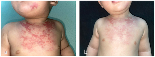 Figure 1 (a) Prior to treatment. (b) The plaques were lighter in color after one year of treatment.