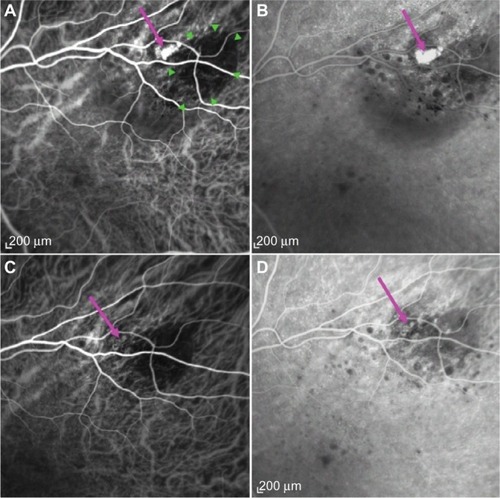 Figure 2 Regression of polyp after PDT laser.