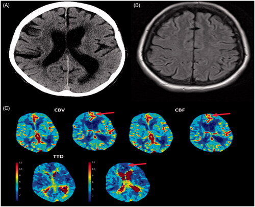 Figure 4. An 85-year-old female presented with expressive aphasia. A,B: Axial computed tomography (CT) head, CT angiogram (not included), magnetic resonance imaging (MRI) of the brain that also included diffusion-weighted imaging were unremarkable. The patient was discharged with the diagnosis of transient ischaemic attack (TIA). After discharge, the patient continued to have recurrent similar episodes. C: CT perfusion during one of her episodes demonstrated left frontal focal hyperperfusion characterized by increased cerebral blood flow (CBF), cerebral blood volume (CBV) and decreased time to drain (TTD). The patient was diagnosed with focal seizure with preserved awareness.
