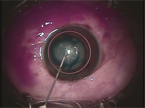 Figure 2 The tension surface of the air bubble spreads the dye on the anterior capsule.