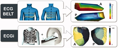 Figure 2. ECG belt and ECGi technologies are shown. The patient wears the ECG belt or ECGi vest and electroanatomical maps can be created for electrical substrate analysis. A: anterior view. P: posterior view.