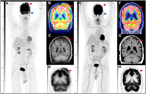 Figure 2 Initial and Post-Treatment FDG PET-MRI. Composite fused FDG PET-MRI images at initial diagnosis and after treatment with R-CHOP alternating with R-MA. Coronal view of FDG PET maximum intensity projection (MIP) at initial diagnosis (A) demonstrates moderately hypermetabolic soft tissue in the scalp subcutaneous tissues with SUV max of 7.8 (red arrow). The subcutaneous tissue has transcalvarial extension and involvement of the underlying pachymeninges as seen on fused coronal FDG PET-MRI (B), T1 MRI (C), and FDG PET (D) (red arrows). Initial FDG PET MIP (A) also demonstrates hypermetabolic left preauricular lymph nodes and temporalis muscle involvement (blue arrow). Post-treatment fused FDG PET-MRI MIP (E) demonstrates complete resolution of the scalp subcutaneous tissues (red arrows) and lymphadenopathy (blue arrow) and is confirmed on coronal fused PET-MRI (F), T1 + contrast (G) and FDG PET (H) (red arrows).